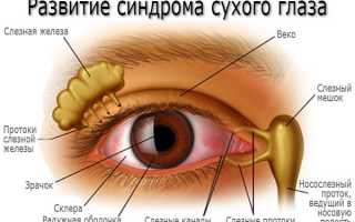 Что за болезнь сухой глаз, симптомы, лечение, капли