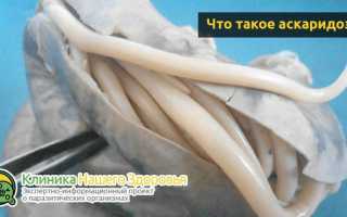 Как развивается аскаридоз, симптомы и лечение
