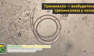 Трихинеллез: причины, симптомы, профилактика и лечение болезни