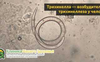 Трихинеллез: причины, симптомы, профилактика и лечение болезни