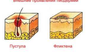Пиодермии в нашей жизни
