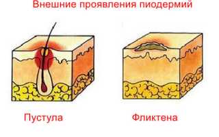 Пиодермии в нашей жизни