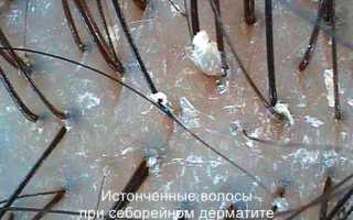 Себорейный дерматит в подробностях
