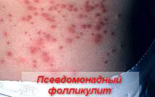 Что такое фолликулит, классификация, симптомы и лечение