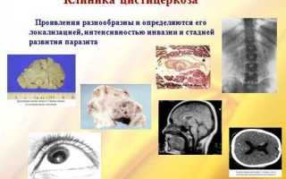 Цистицеркоз: симптомы, диагностика и лечение заболевания