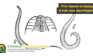 Острицы у взрослых — симптоматика и избавление
