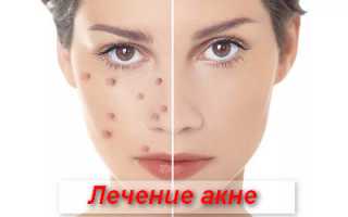 Лечение акне — схемы и рекомендации