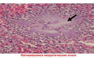 Актиномикоз – инфекция, которая сложно диагностируется