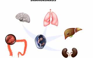 Эхинококкоз: симптомы, диагностика и лечение заболевания