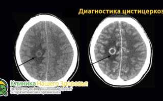 Паразиты в мозге: симптомы и лечение болезни