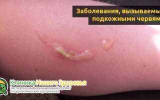 Паразиты и черви под кожей человека