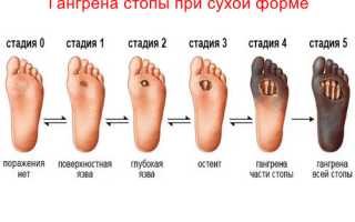 Гангрена при сахарном диабете — как диабет повреждает сосуды и ткани