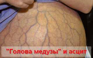 Чем опасен цирроз печени, симптомы и лечение