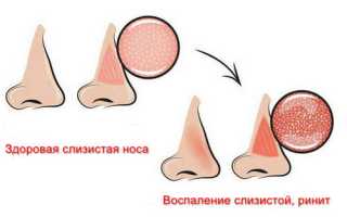 Что такое ринит — осложнения