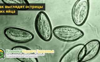 Энтеробиоз: симптомы, причины, лечение и профилактика