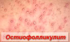 Импетиго — что это такое и как лечить
