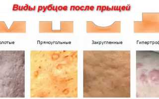 Как осуществляется восстановление кожи после акне — варианты
