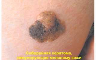 Себорейный кератоз кожи – с возрастом проблемы обостряются