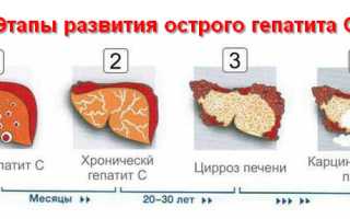 Острый гепатит С, симптомы и лечение