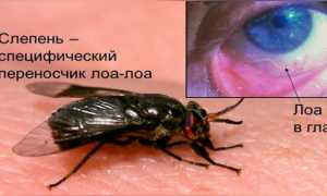 Лоаоз – симптомы и лечение гельминтоза