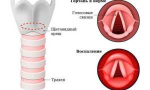 Ларингит не только охриплость, но и воспаление гортани
