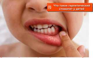 Как определять герпетический стоматит у детей