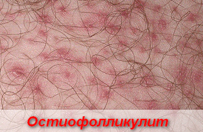 остиофолликулит