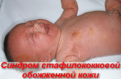 синдром стафилококковой обожженной кожи