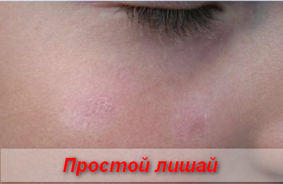 сухая стрептодермия