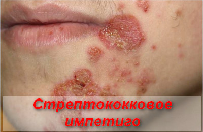стрептококковое импетиго