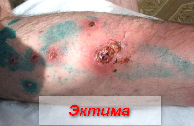 эктима