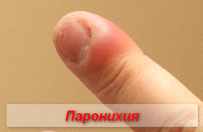 паронихия