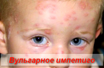 вульгарное импетиго