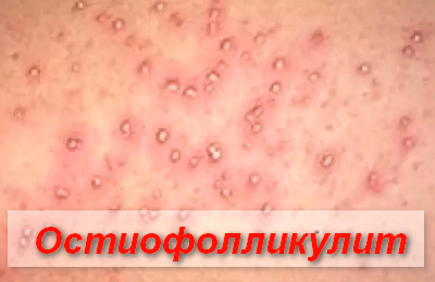 остиофолликулит