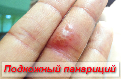 подкожный панариций