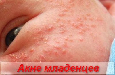 акне новорожденных