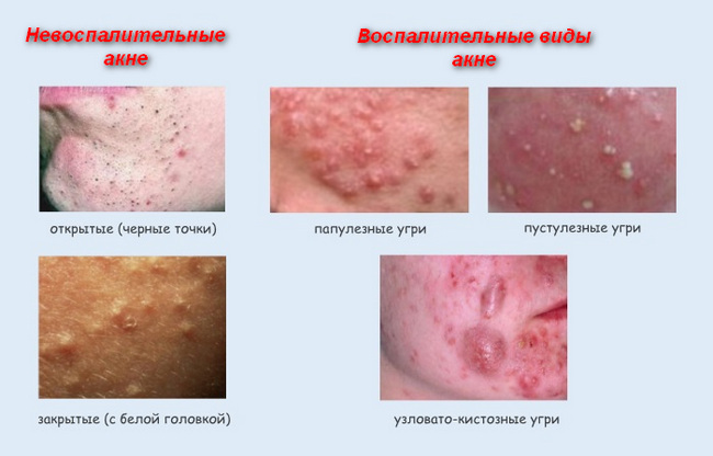 виды угревых высыпаний