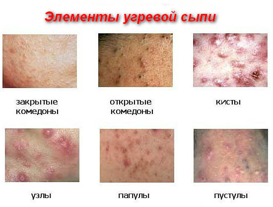 элементы угревой сыпи