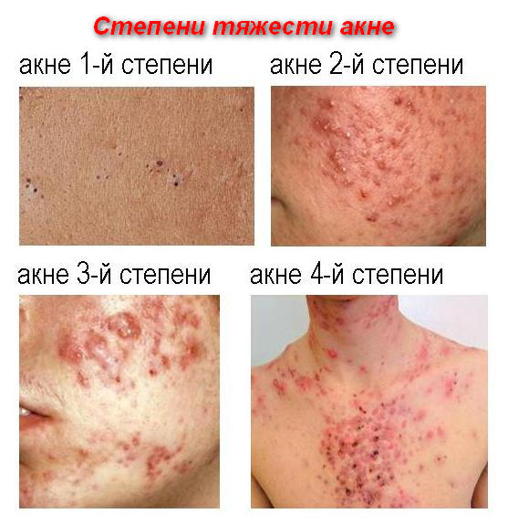 степени тяжести заболевания