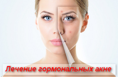 лечение гормональных акне