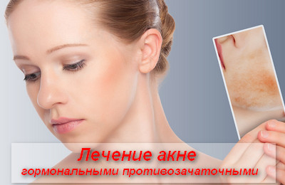 лечение акне гормональными противозачаточными