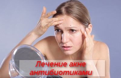 лечение акне антибиотиками