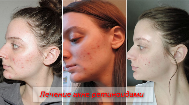 лечение акне ретиноидами