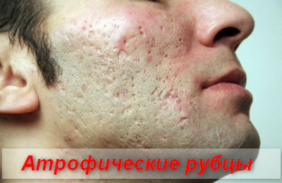 атрофические рубцы