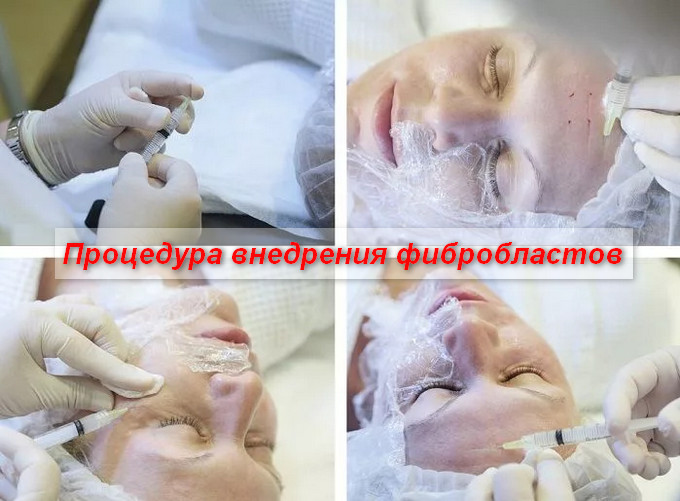 коррекция рубцов фибробластами