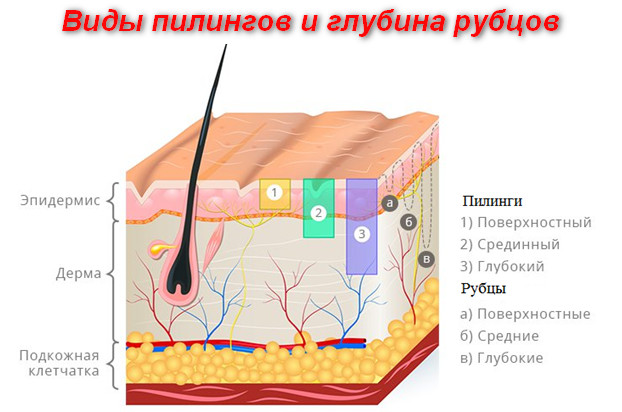 виды пилингов