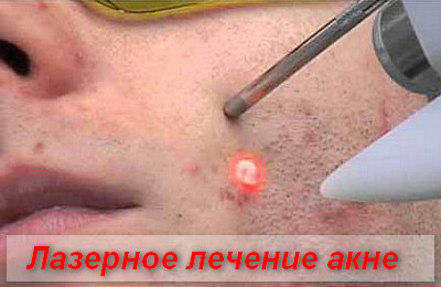лазерное лечение акне