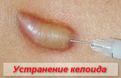 устранение келоида