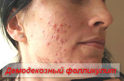 демодекозный фолликулит