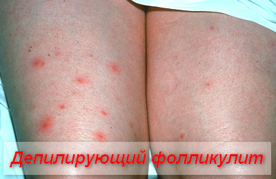 депилирующий фолликулит